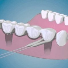 TePe Bridge & Implant Floss zubná niť, 5ks (sáčok)