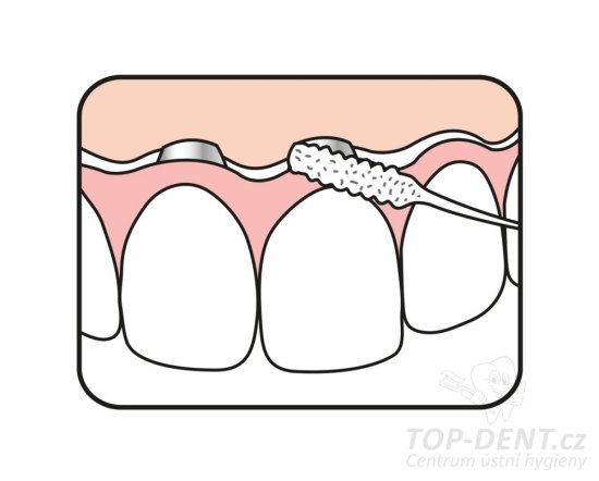 TePe Bridge & Implant Floss zubní nit, 30ks