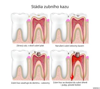 Jak se kazí zub?