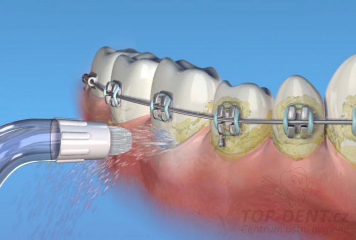 Waterpik Orthodontic trysky OD100, 2ks